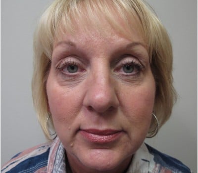 Before Image: 56 yo had fat injections & Lipo in neck - front