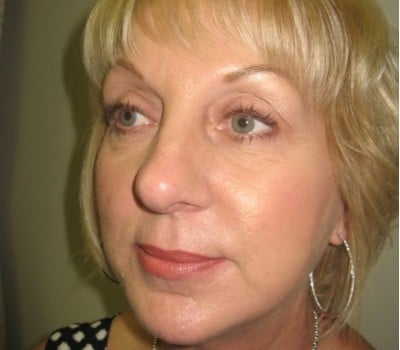 After Image: 56 yo had fat injections & Lipo in neck - other