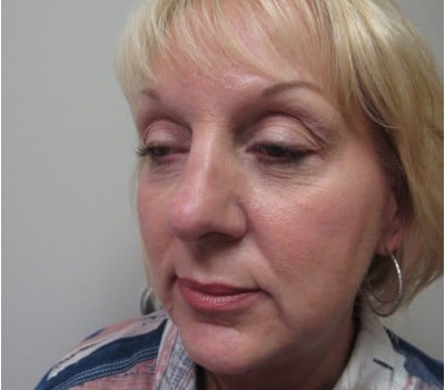 Before Image: 56 yo had fat injections & Lipo in neck - other