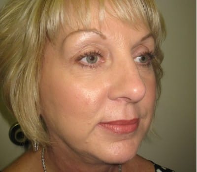 After Image: 56 yo had fat injections & Lipo in neck - other