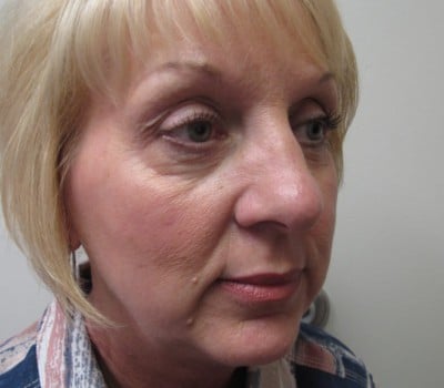 Before Image: 56 yo had fat injections & Lipo in neck - other