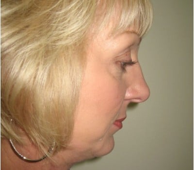 After Image: 56 yo had fat injections & Lipo in neck - front