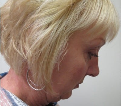 Before Image: 56 yo had fat injections & Lipo in neck - front