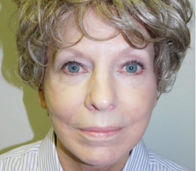 After Image: 73yo facelift with simultaneous liposuction of the neck. - front
