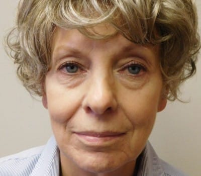 73yo facelift with simultaneous liposuction of the neck.