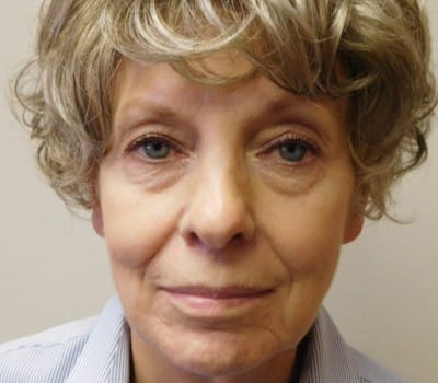 Before Image: 73yo facelift with simultaneous liposuction of the neck. - front