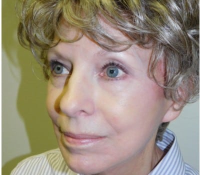 After Image: 73yo facelift with simultaneous liposuction of the neck. - front
