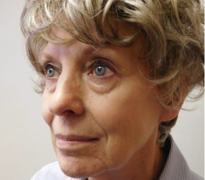 Before Image: 73yo facelift with simultaneous liposuction of the neck. - front