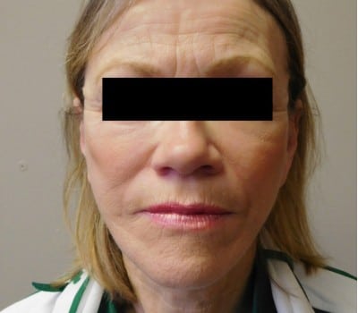 After Image: Face Lift - front