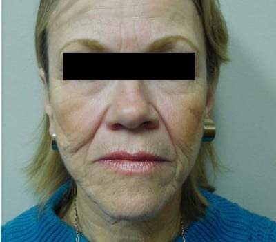 Before Image: Face Lift - front