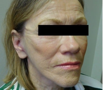 After Image: Face Lift - other