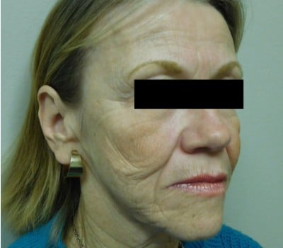 Before Image: Face Lift - other