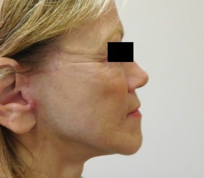 After Image: Face Lift - front