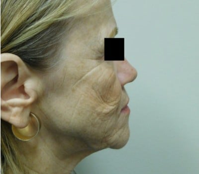 Before Image: Face Lift - front
