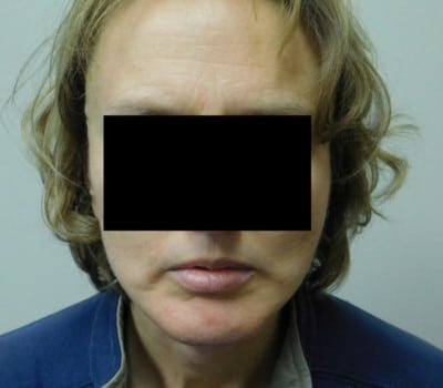 After Image: 48 year old with Chin Augmentation - front