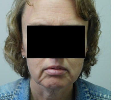 Before Image: 48 year old with Chin Augmentation - front