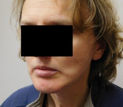 After Image: 48 year old with Chin Augmentation - front