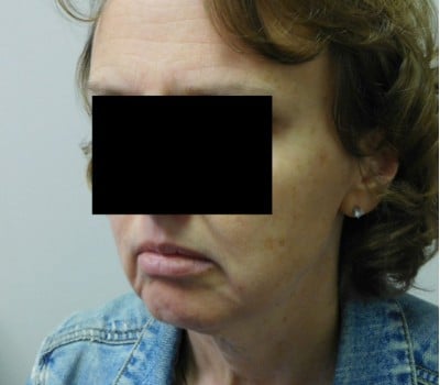 Before Image: 48 year old with Chin Augmentation - front