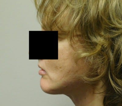 After Image: 48 year old with Chin Augmentation - front