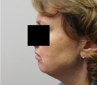 Before Image: 48 year old with Chin Augmentation - front