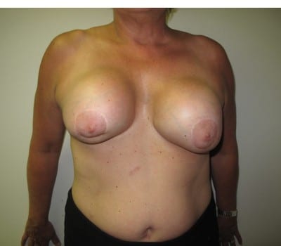 Before Image: Complex Breast Issues - front