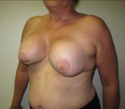 Before Image: Complex Breast Issues - other
