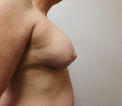 After Image: Complex Breast Issues - other