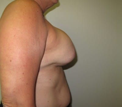 Before Image: Complex Breast Issues - other