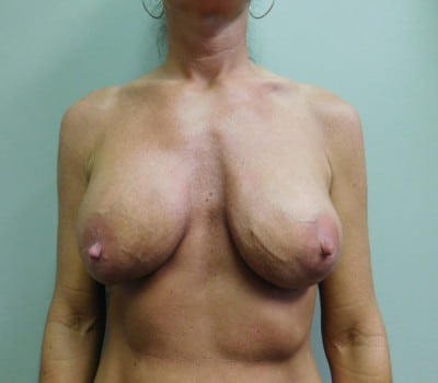 After Image: Complex Breast Issues - front