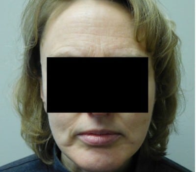 After Image: Face Lift - front
