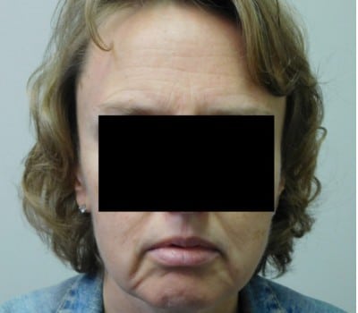 Before Image: Face Lift - front