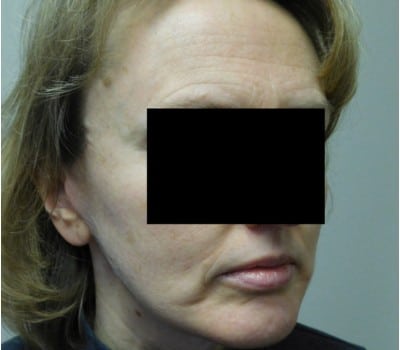 After Image: Face Lift - other
