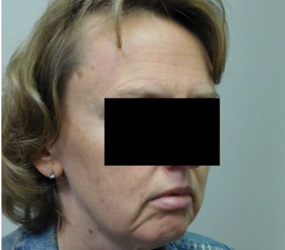 Before Image: Face Lift - other