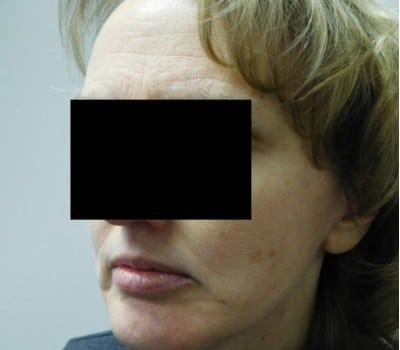After Image: Face Lift - other