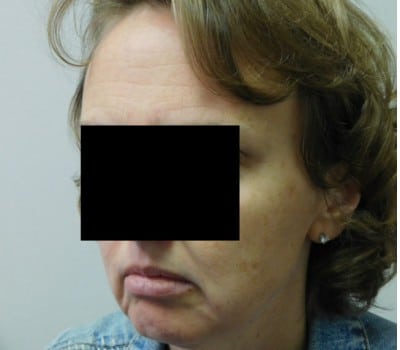 Before Image: Face Lift - other
