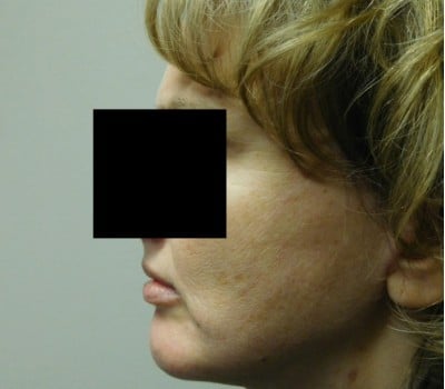 After Image: Face Lift - other