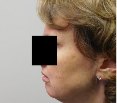 Before Image: Face Lift - other