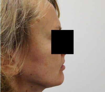 After Image: Face Lift - other