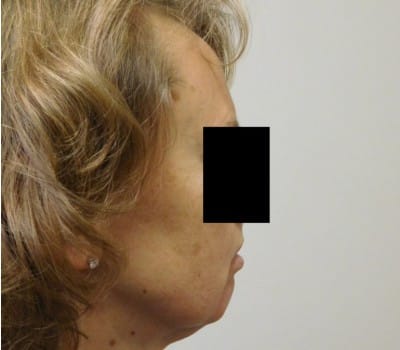 Before Image: Face Lift - other