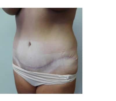 After Image: Abdominoplasty - other