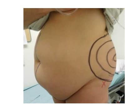 Before Image: Abdominoplasty - other