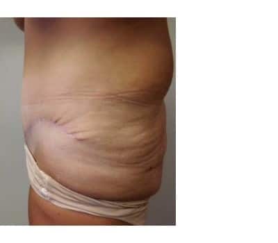 After Image: Abdominoplasty - other