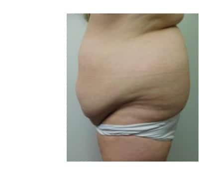 Before Image: Abdominoplasty - other