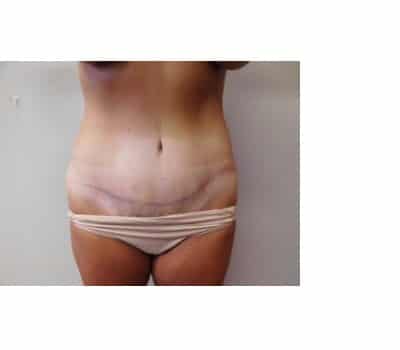 After Image: Abdominoplasty - front