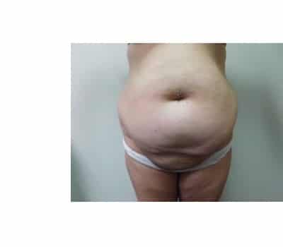 Before Image: Abdominoplasty - front