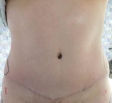 After Image: Abdominoplasty - front