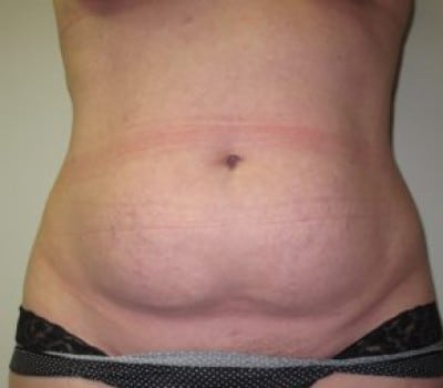 Before Image: Abdominoplasty - front