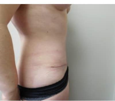 After Image: Abdominoplasty - other