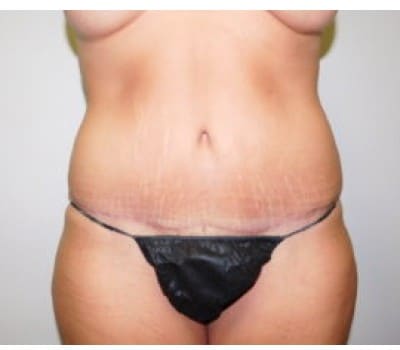 After Image: Abdominoplasty - front