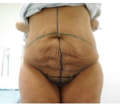 Before Image: Abdominoplasty - front